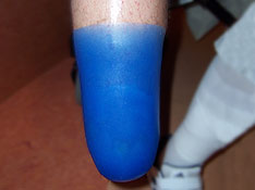 Individuelles TF Distalcup f&uuml;r Oberschenkelschaft