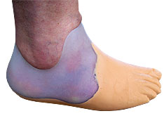 Probe Vorfu&szlig;prothese